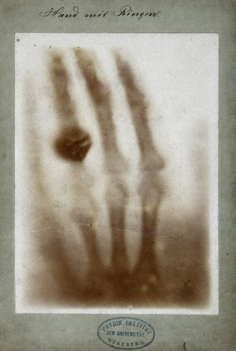 manbet手机版手环:打印的第一个威廉伦琴的x光照片