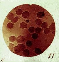 manbet手机版的典型rosette-shape malarian寄生虫,红细胞。