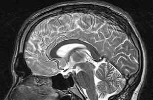 manbet手机版大脑MRI图像